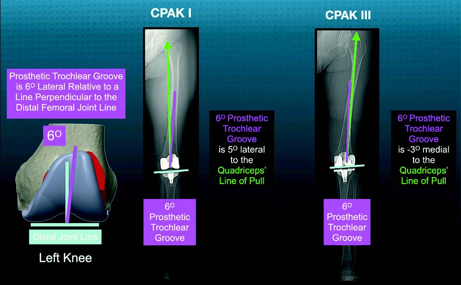 CPAK 1